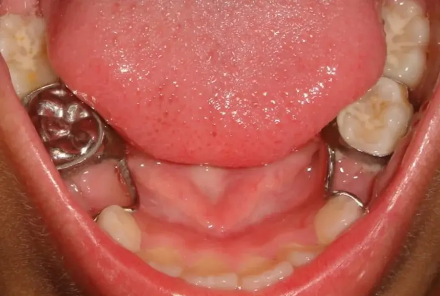 Metal appliances fitted on a child's lower back teeth