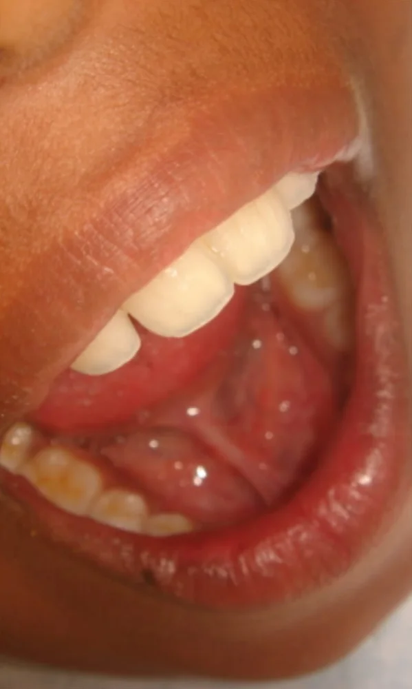 A child's open mouth, seen from the side