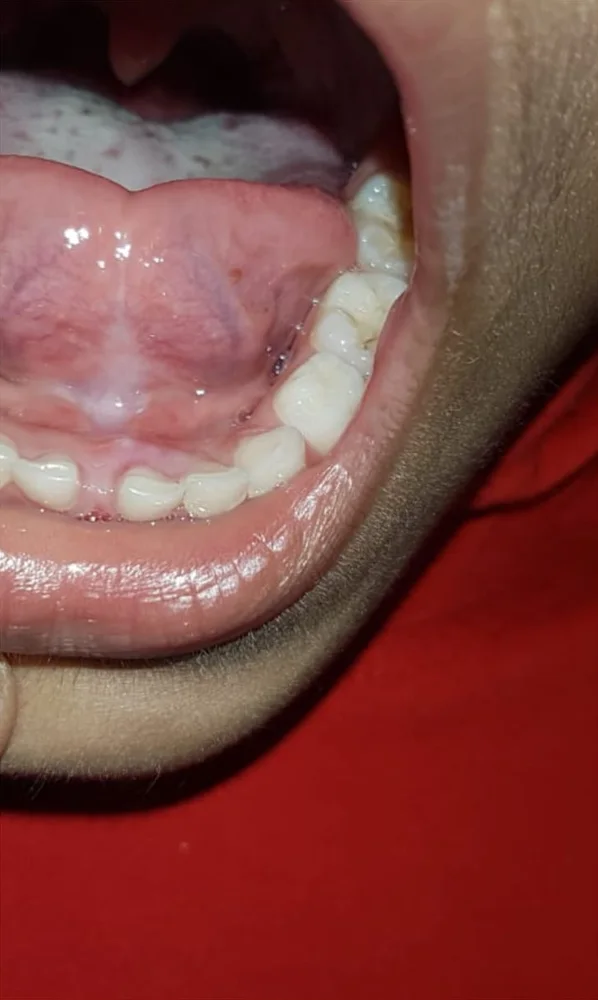 A child's lower teeth and tongue