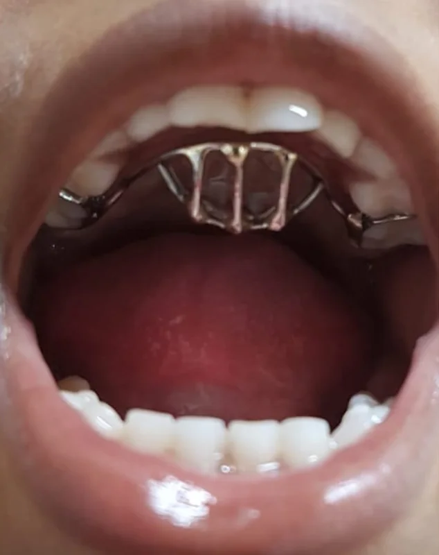 A fixed appliance fitted to the roof of a child's mouth