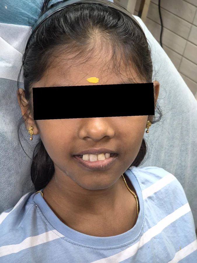 A young patient smiling after treatment, her front teeth restored