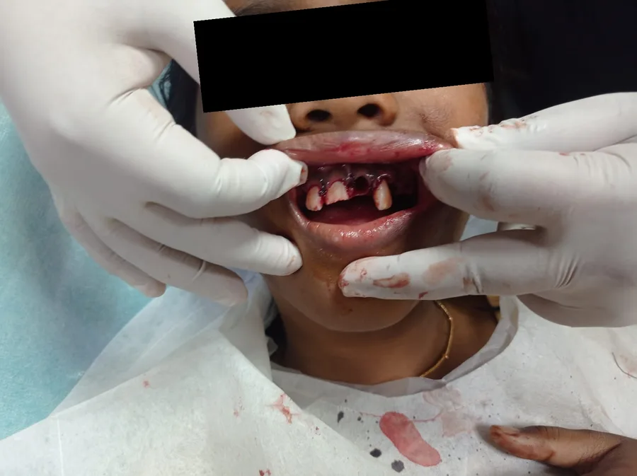 The same injury on the day it happened: upper front teeth knocked out and broken, the lip held back by gloved hands
