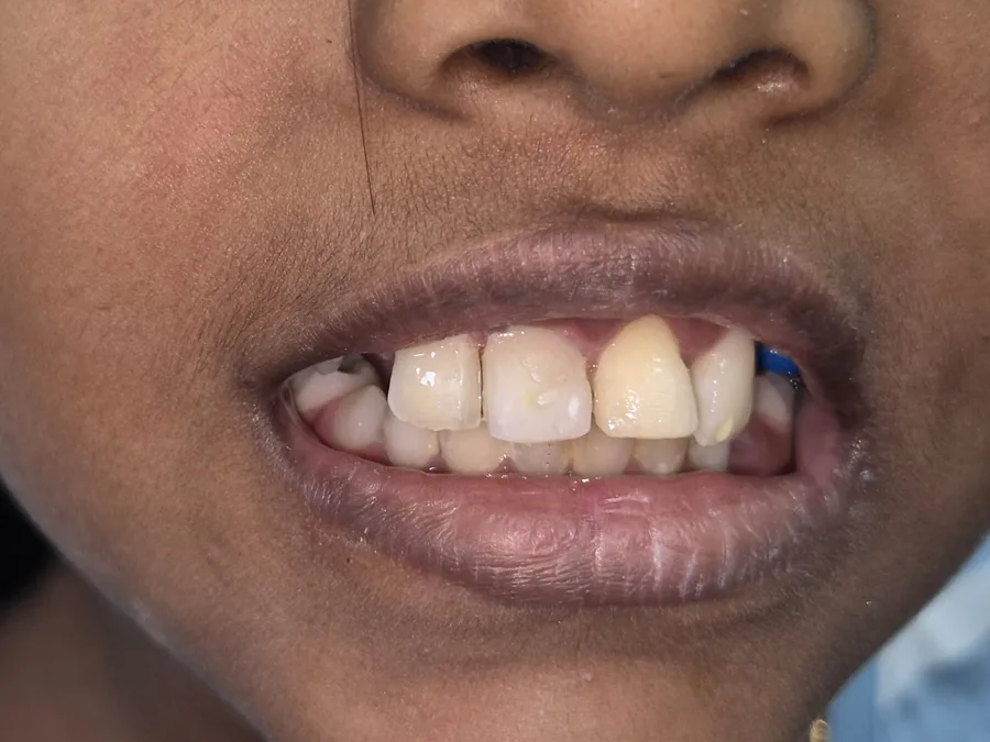 A close view of upper front teeth rebuilt after an injury
