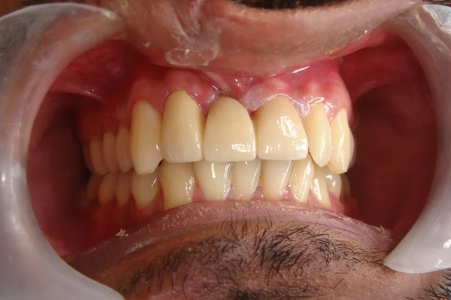 Upper front teeth restored with crowns after an injury, the lips held back with retractors