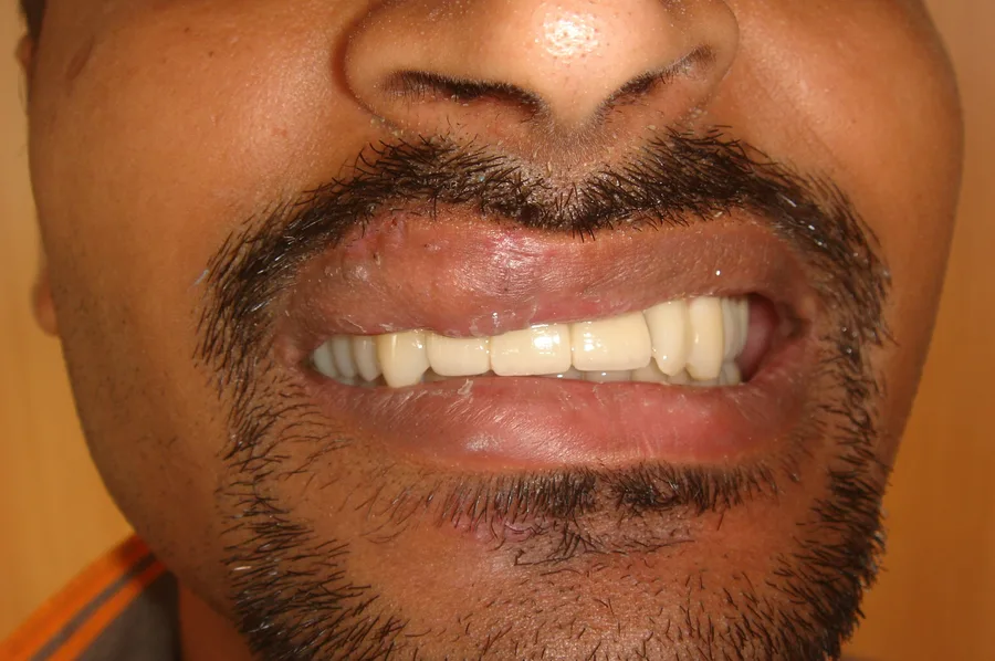 The same patient's smile after his front teeth were restored