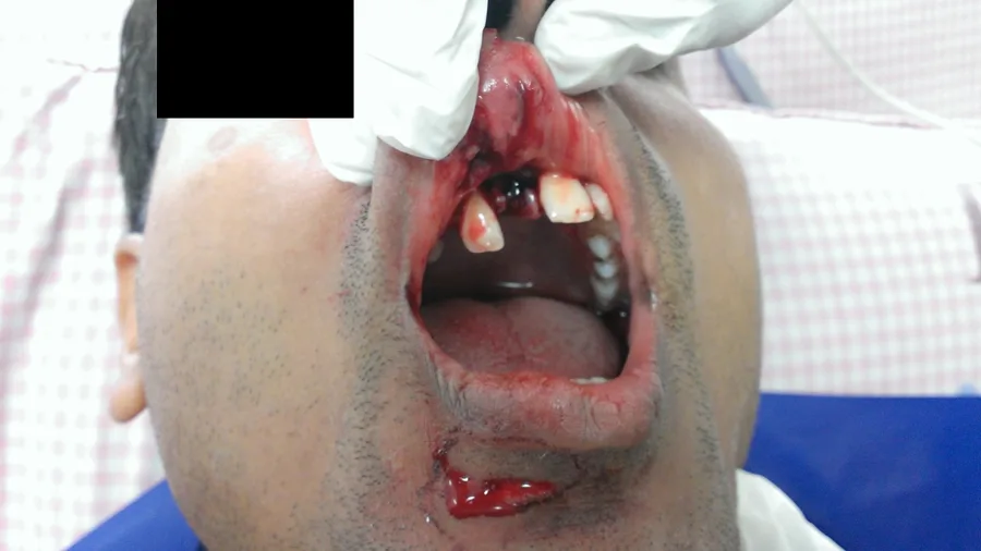 An injury to the upper lip and front teeth, with a cut on the chin, on the day it happened