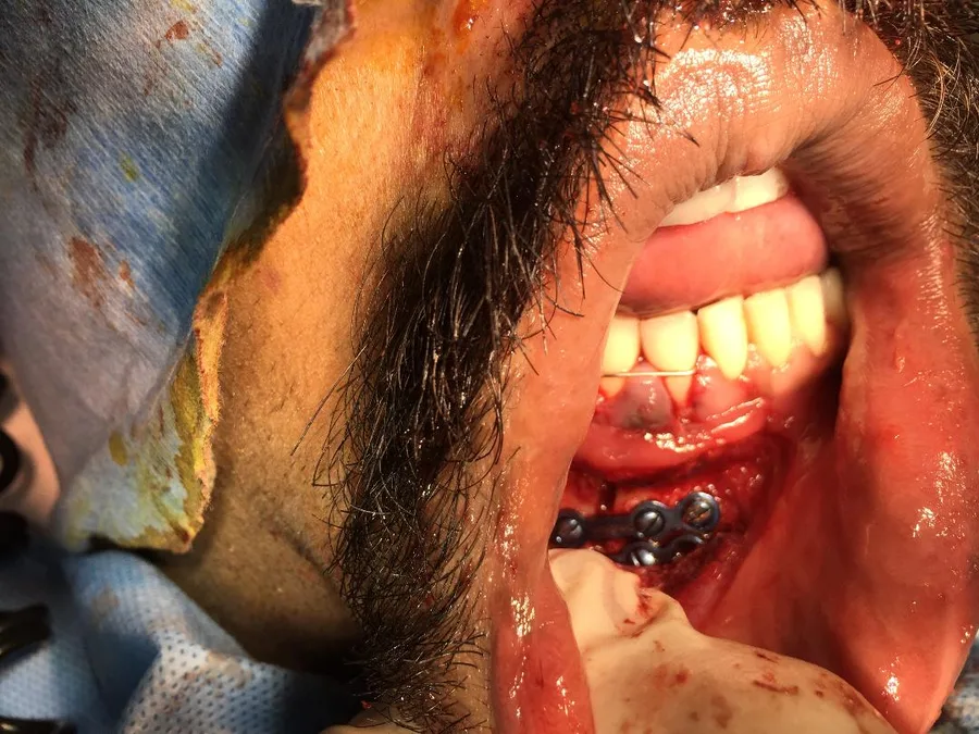 A broken lower jaw fixed with a small metal plate and screws during surgery