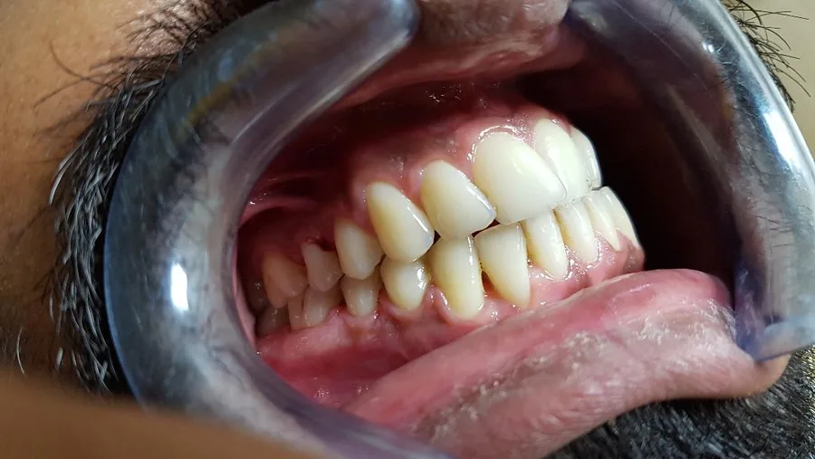 Teeth seen from the side after treatment, the cheek held back with a retractor