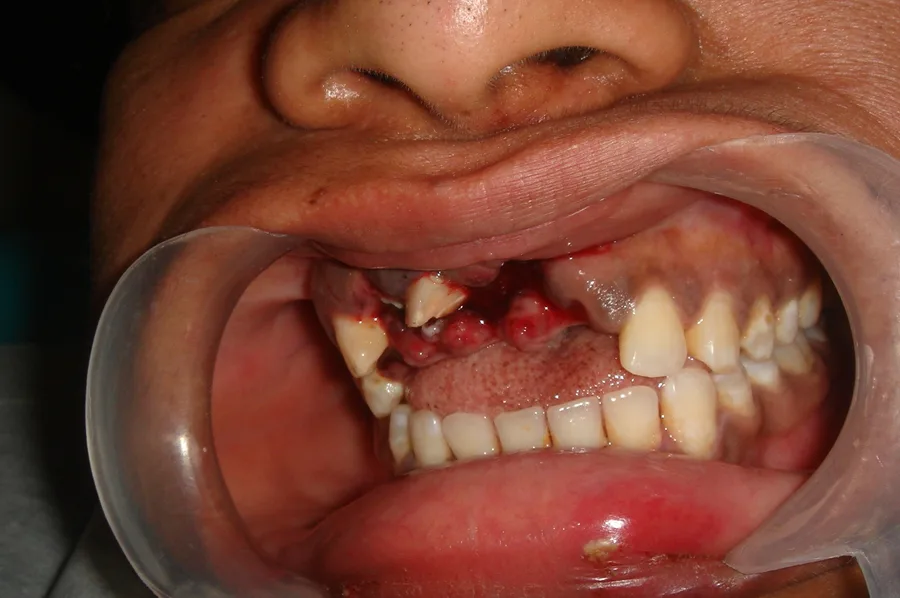 Upper front teeth broken and displaced by an injury, before treatment