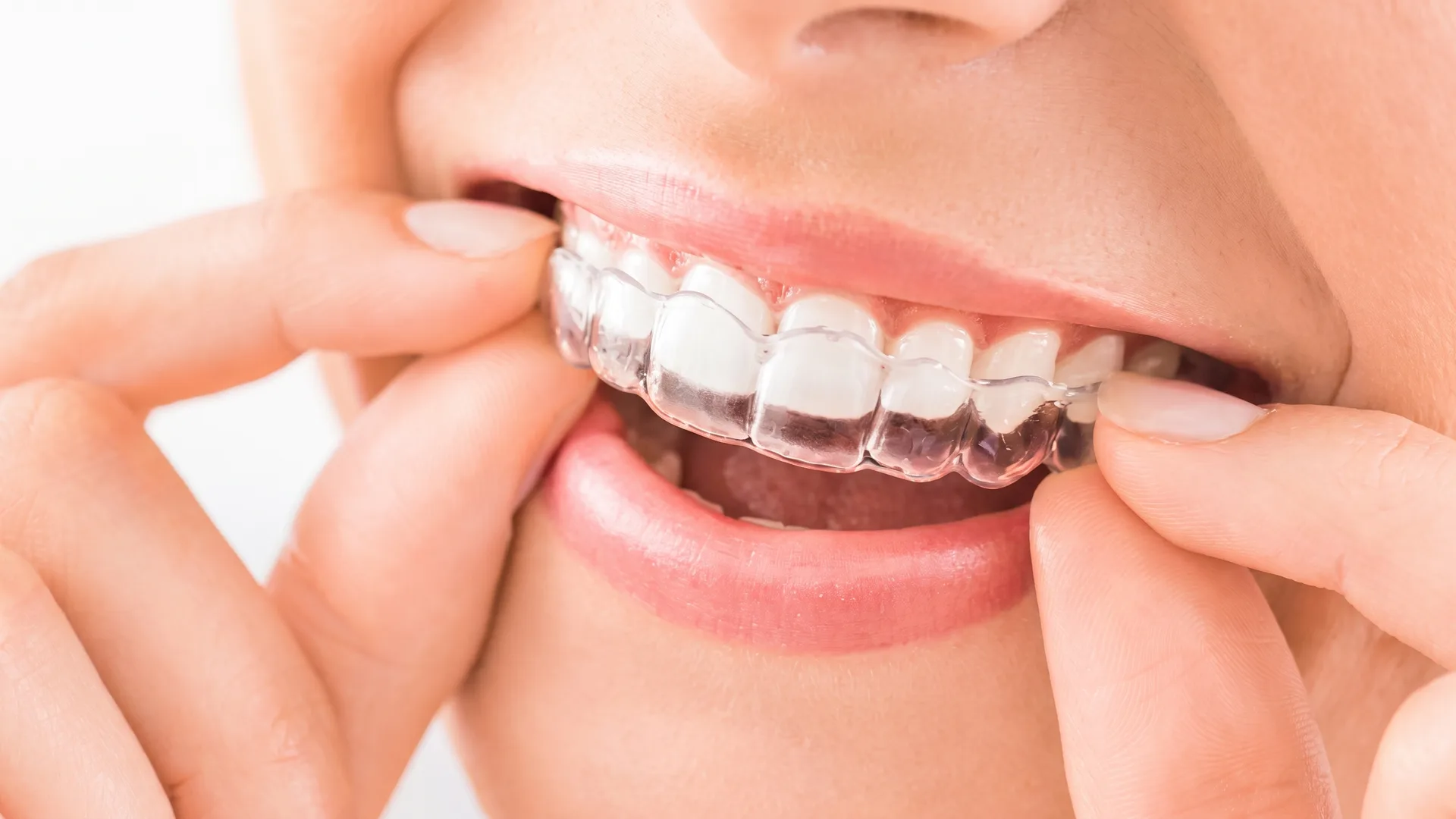 A clear aligner being fitted over the upper teeth