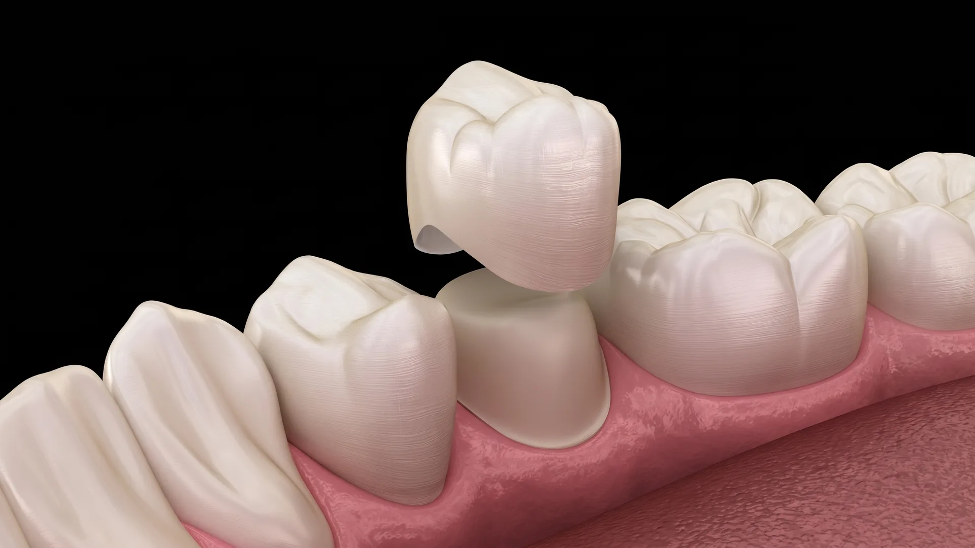 Illustration of a crown being placed over a prepared tooth