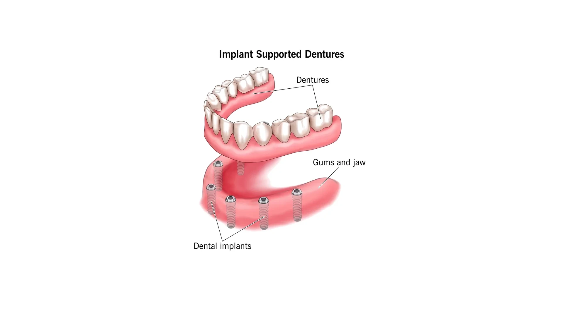 Labelled diagram of an implant supported denture