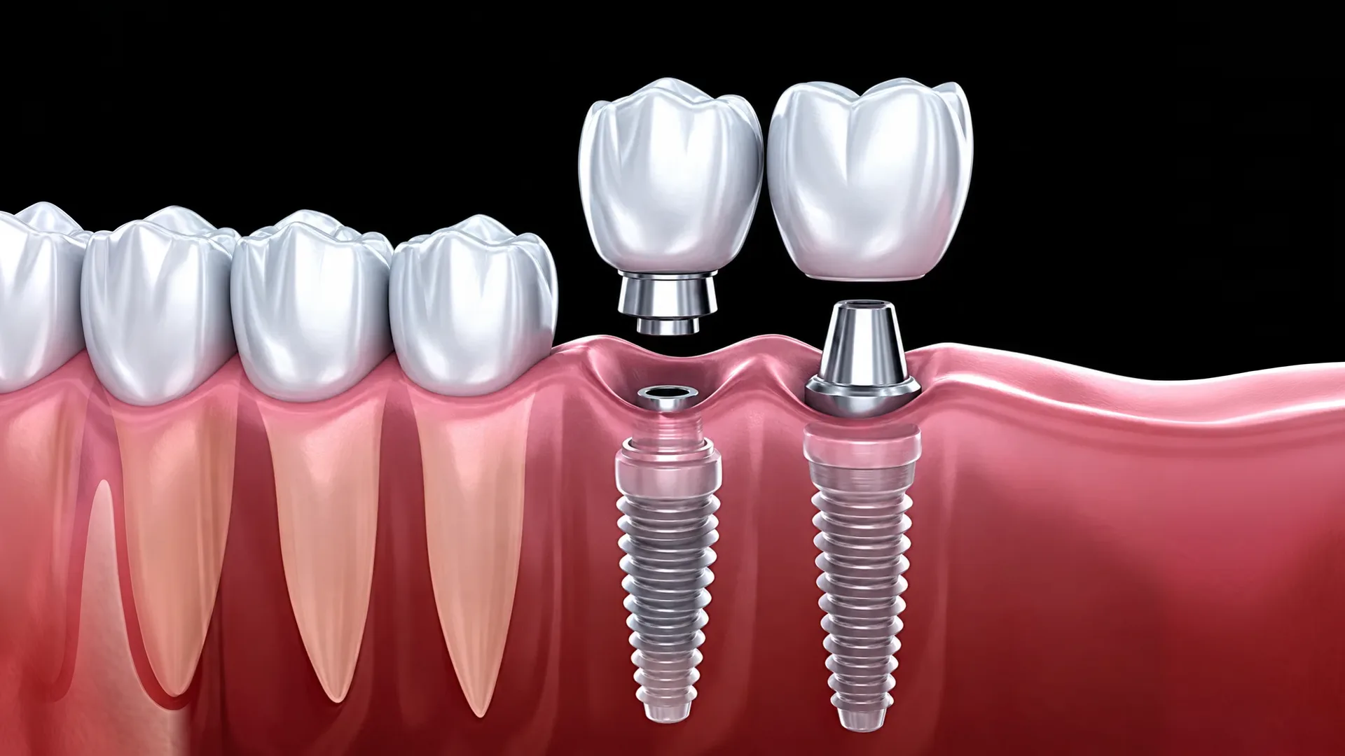 Illustration of dental implants supporting crowns