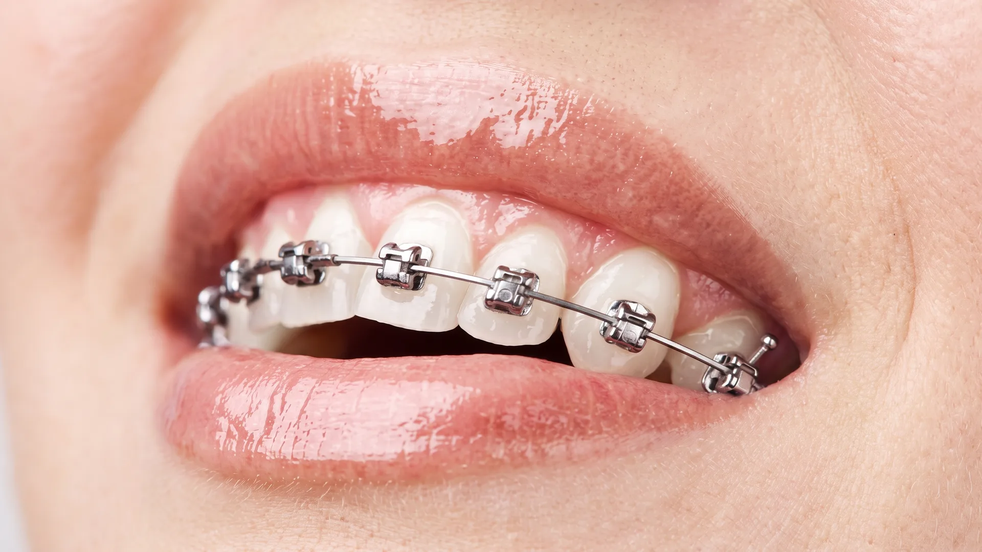 Metal braces on a smile, close up