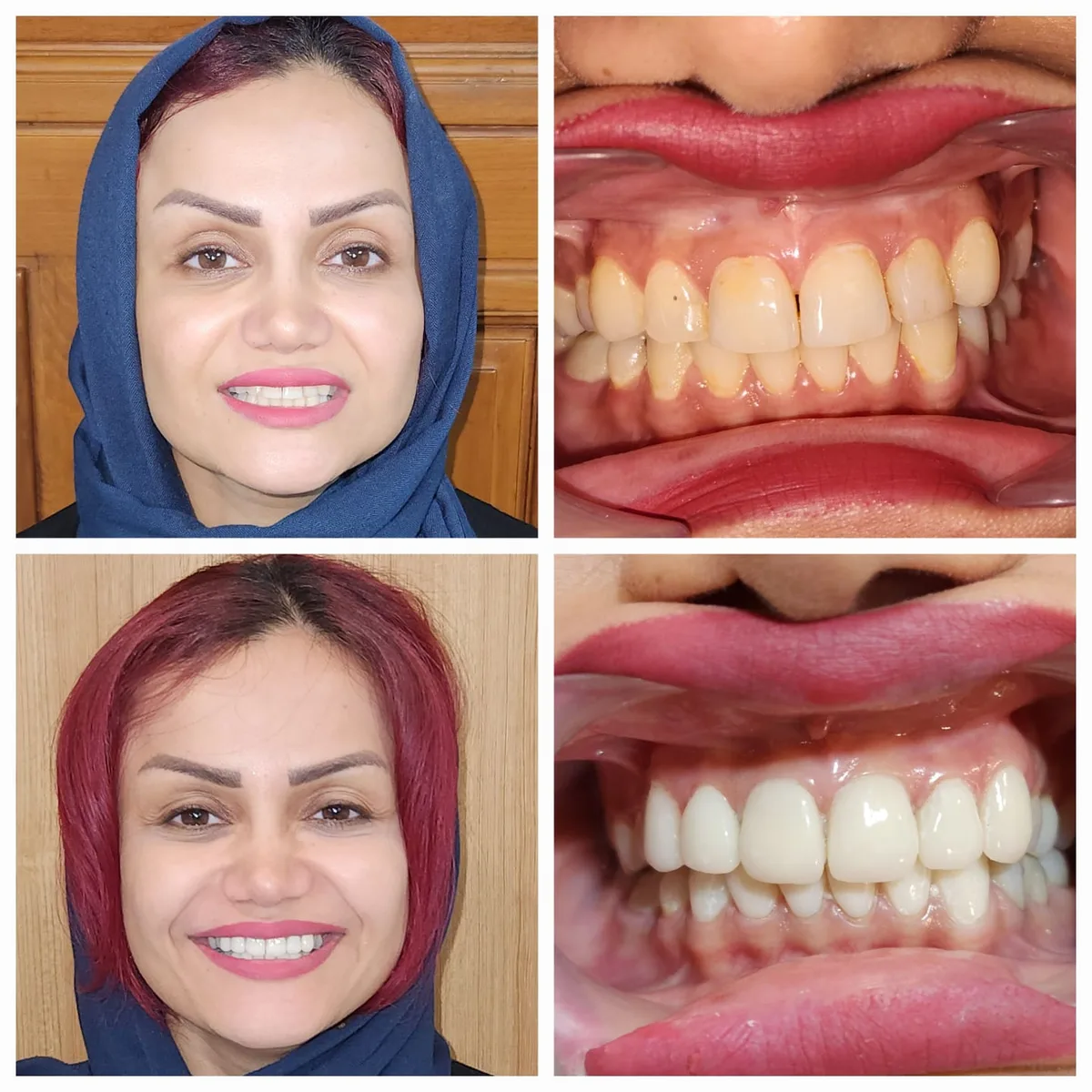 Zainab Ali before and after treatment: her smile and her teeth before, above, and after, below