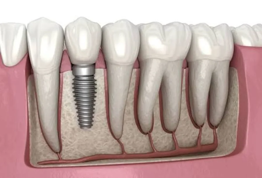 Illustration of a dental implant