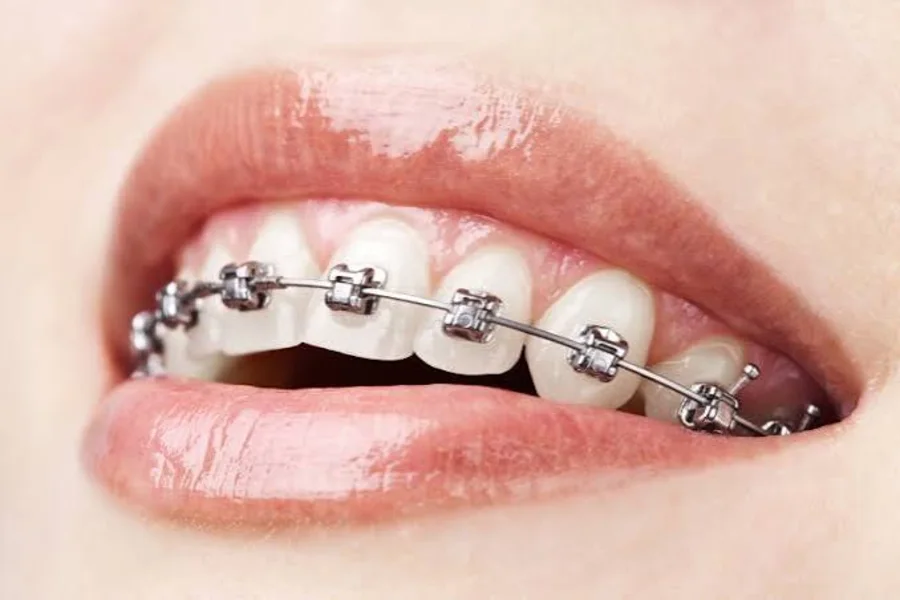 Braces close-up