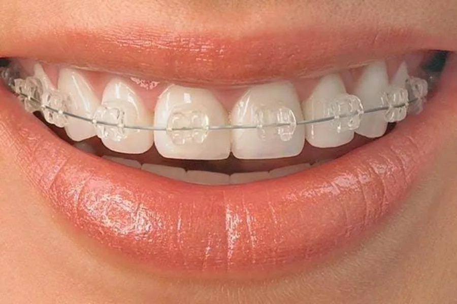 Clear braces close-up