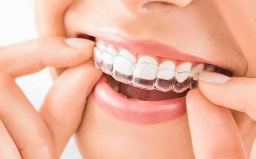 Fitting a clear aligner
