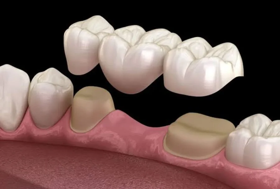 Illustration of a dental bridge