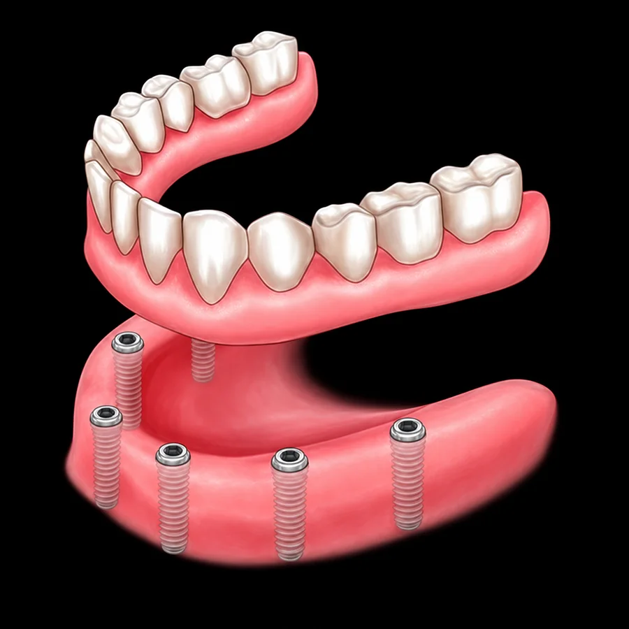 Illustration of implant-supported dentures