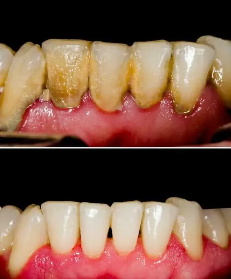 Before and after teeth cleaning